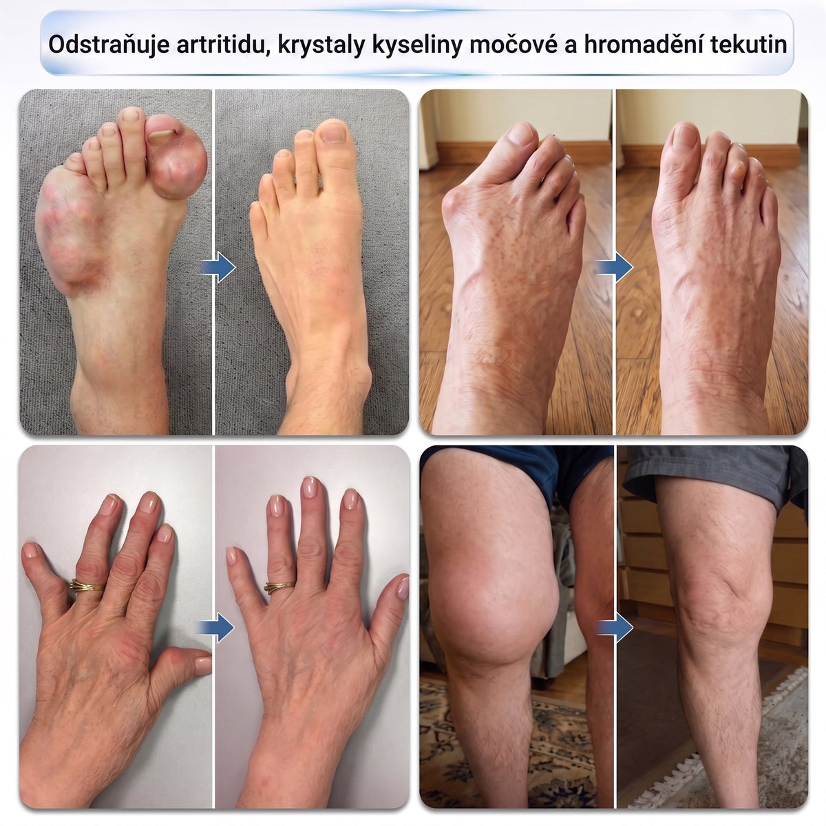 🌿XRLXRL®🪄 TECHNOLOGIE ORTOPEDICKÉ REGENERACE NOVÉ GENERACE · 0,05mm mikrojehličkový váleček pro obnovu kostí a kloubů