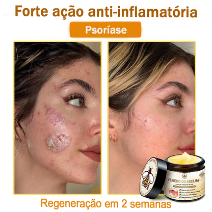 🌿🔥 𝑻𝑳𝑶𝑷𝑨® Creme de Tratamento da Pele com Veneno de Abelha (👨‍⚕️ Com Certificação CE) 👍✅