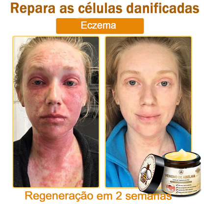 🌿🔥 𝑻𝑳𝑶𝑷𝑨® Creme de Tratamento da Pele com Veneno de Abelha (👨‍⚕️ Com Certificação CE) 👍✅